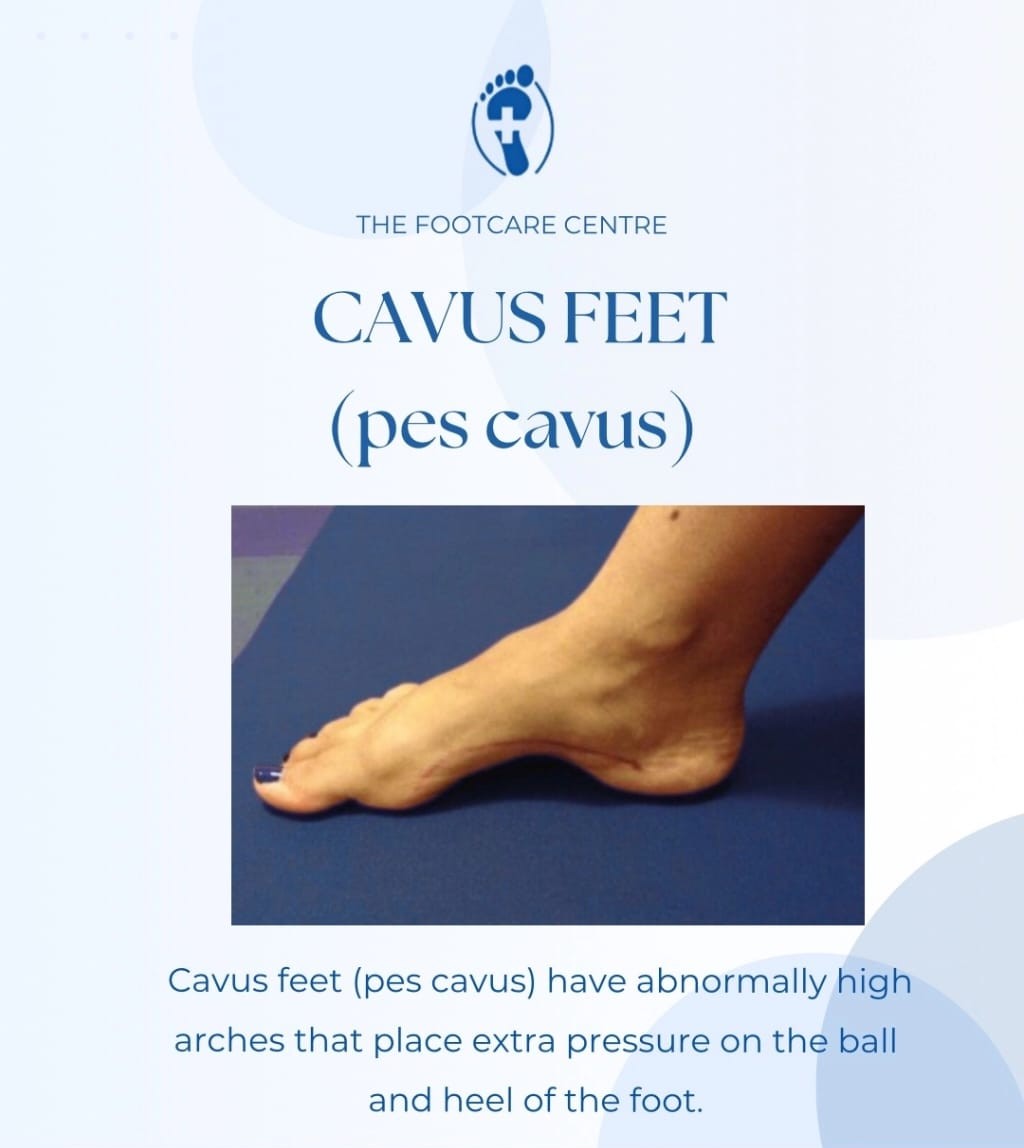High Arched Feet (Cavus)